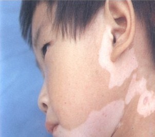 北京治疗白癜风最好医院：儿童白癜风怎么正确饮食